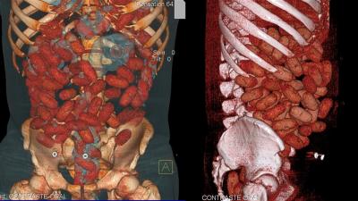 This Is How 72 Bags Of Cocaine Look Inside Your Intestines