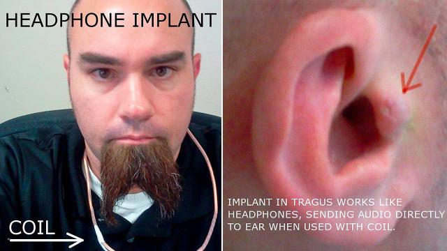 This Guy Has An Invisible Headphone Implanted In His Ear