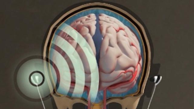 These Earbuds Ping Your Head To Measure Swelling On Your Brain