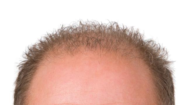 Scientists Just Took A Huge Step Towards Curing Baldness