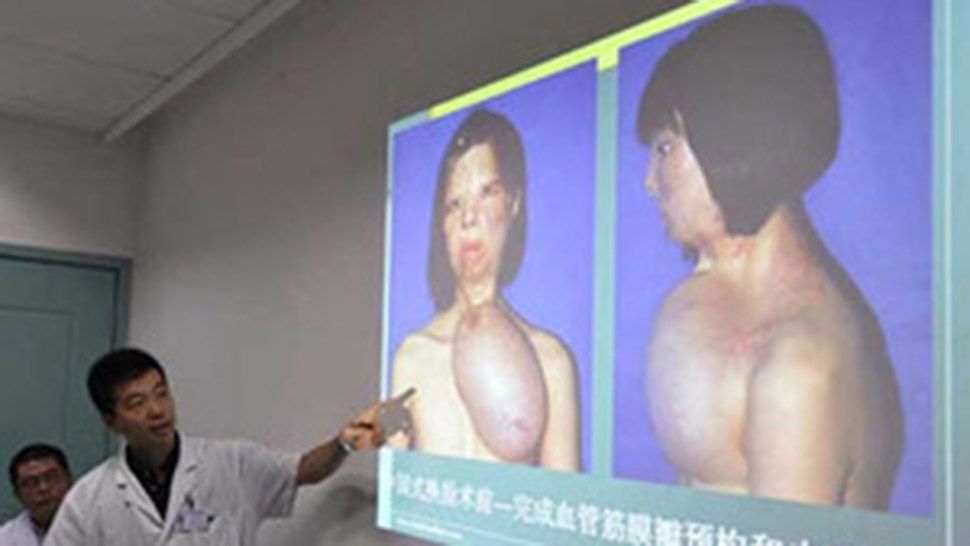 Burned Teen Grows New Face Parts On Her Chest [Warning: Graphic Images]
