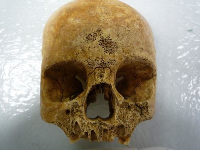 Finally, A Digital Library Of Bizarre Human Bones From The Middle Ages