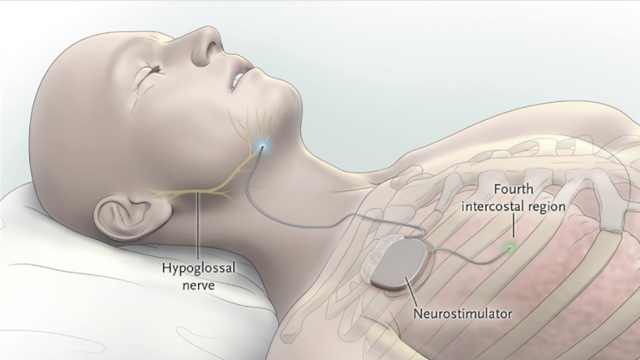 This Electronic Sleep Apnea Cure Is Like Auto-Pilot For Breathing
