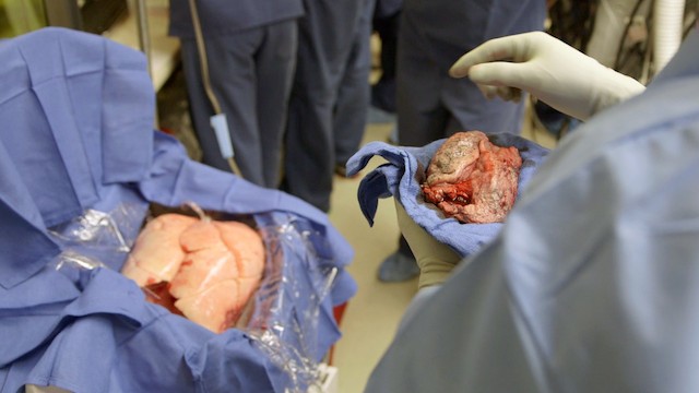 How A Human Lung Is Kept Alive And Breathing For A Transplant