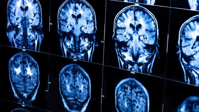 New Test Predicts Alzheimer’s At Least Three Years In Advance