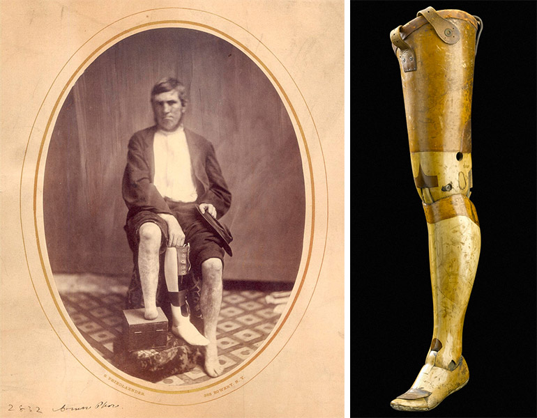 The Fascinating Untold History Of War And Prosthetics