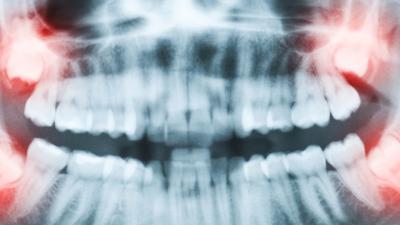 Dentists Found A Pain-Free Cavity Fix That Might Actually Work