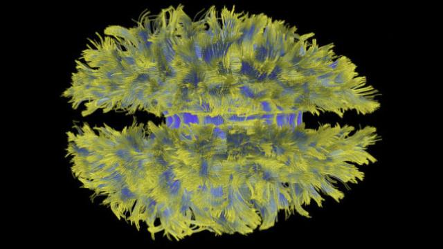 This Isn’t A Fright Wig. It’s How GE’s MRI Scanner Sees Your Brain