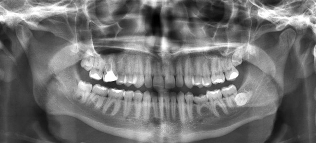 There Are Cells Inside Teeth That Can Turn Back Into Stem Cells