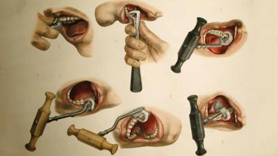 Bloodletting And Bone Brushes: The White-Knuckle Days Of Early Dentistry