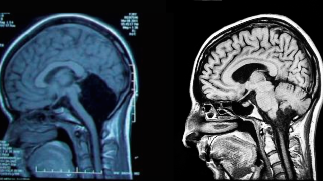 Extremely Rare Case Of Woman With No Cerebellum Puzzles Doctors