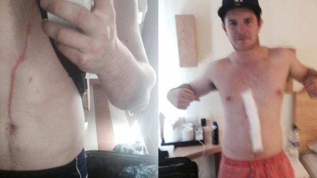 A Spider Apparently Crawled Inside This Australian Man’s Body For Three Days