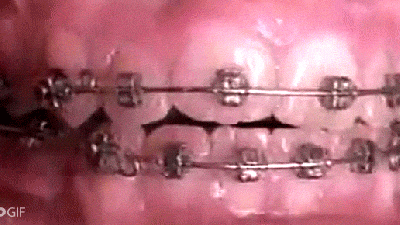 How Braces Can Amazingly Straighten Crooked Teeth