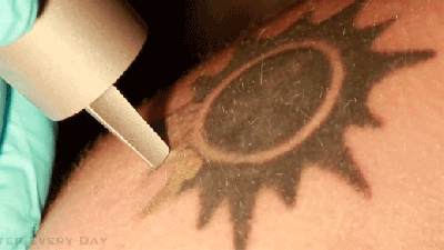 How Removing Tattoos With Lasers Works