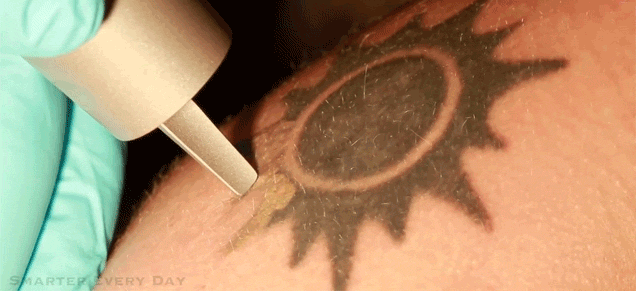 How Removing Tattoos With Lasers Works
