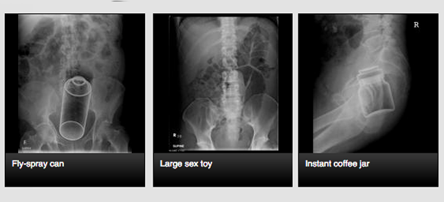 The Site Where Doctors Share X-Rays Of Weird Things In People’s Butts