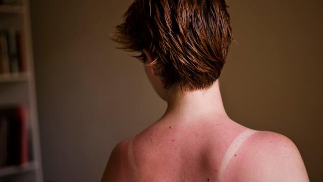 Sun Keeps Damaging Skin Cells For Hours After Exposure