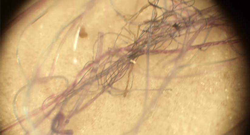 Inside Morgellons, The Internet’s Disease