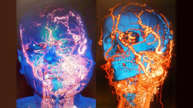A Face Transplant Removed This Deadly Bundle Of Blood Vessels