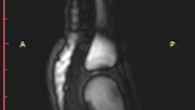 MRI Video Reveals What It Actually Looks Like When You Crack Your Joints