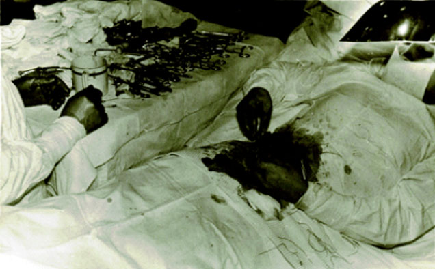 A Soviet Doctor Stranded In Antarctica Had To Cut Out His Own Appendix 