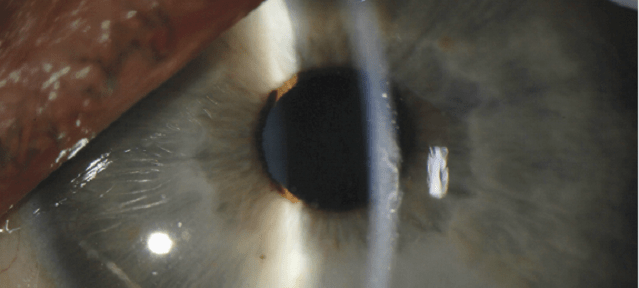 Doctors Just Discovered The Ebola Virus Can Live Inside The Eye