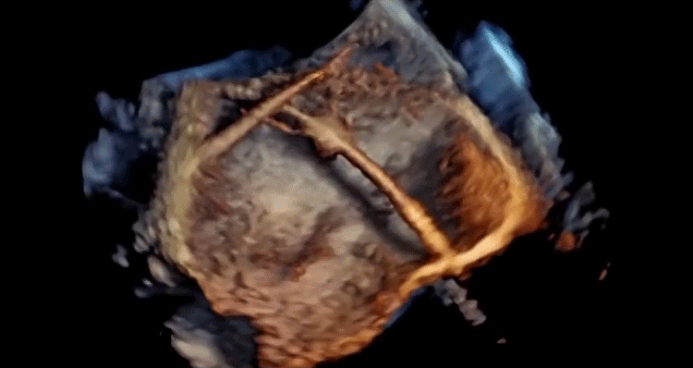We Can Now See Stunning Real-Time 4D Images Of The Heart