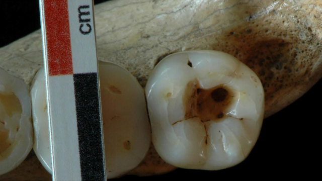 Details Of Earliest Human Dentistry Make Me Want To Cry