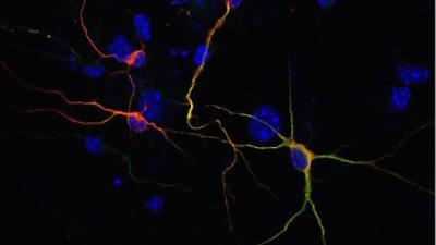 Scientists Turn Skin Cells Into Brain Cells, Using Alzheimers Patients