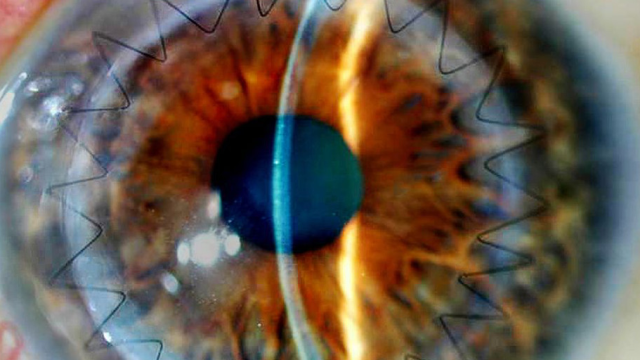 How Neurosurgeons Can Now Look At Your Brain Through Your Eyes