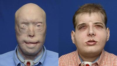 Behold The Most Extensive Face Transplant In Medical History