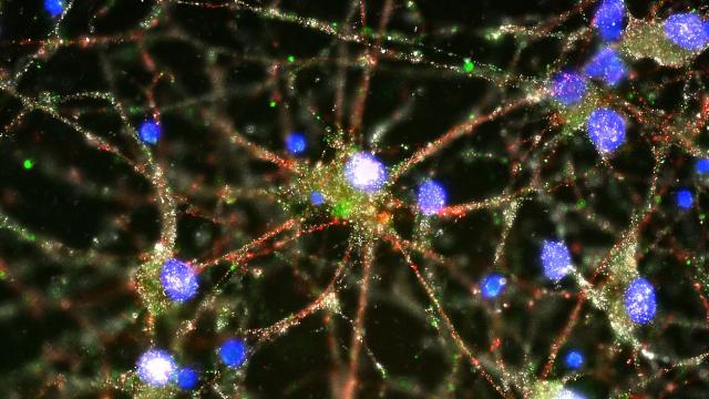 Scientists Have Finally Found A Biological Process Behind Schizophrenia