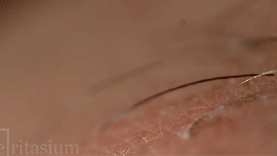 Slow Motion Laser Hair Removal Is A Tiny Massacre