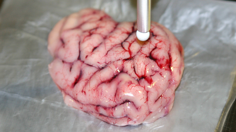Smart Scalpel Can Distinguish Between Healthy And Cancerous Brain Tissue