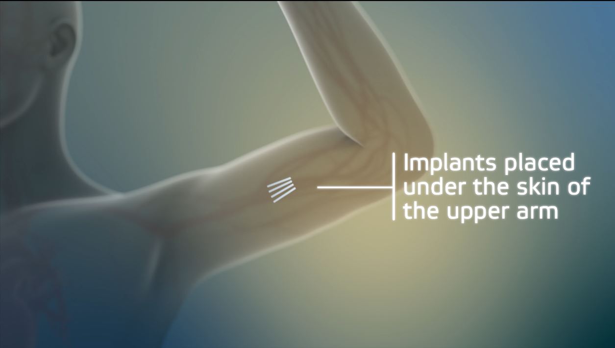 FDA Approves First Implant To Treat Opioid Addiction