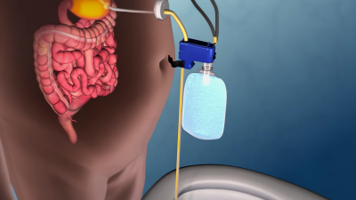 New Weight-Loss Device Sucks Food Directly Out Of Your Stomach