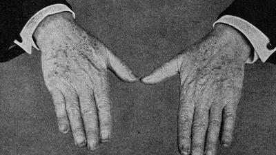 This Photo Of Thomas Edison’s Hands Was Clickbait In 1919