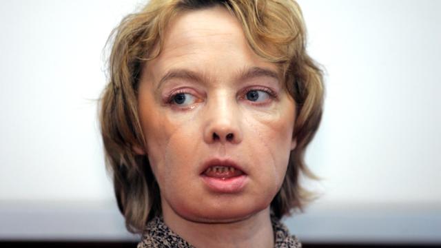 The World’s First Face Transplant Recipient Has Died