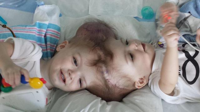 13-Month-Old Twins Conjoined At The Head Successfully Separated