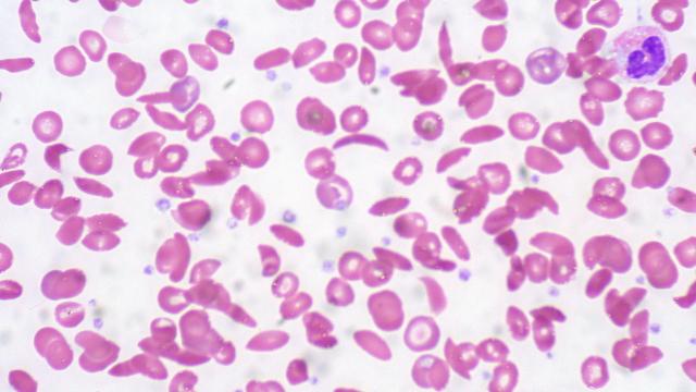 Will Sickle Cell Be The Next Disease Genetic Engineering Cures?