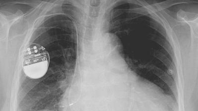 There Are ‘Thousands’ Of Bugs Making Pacemakers Vulnerable To Hackers
