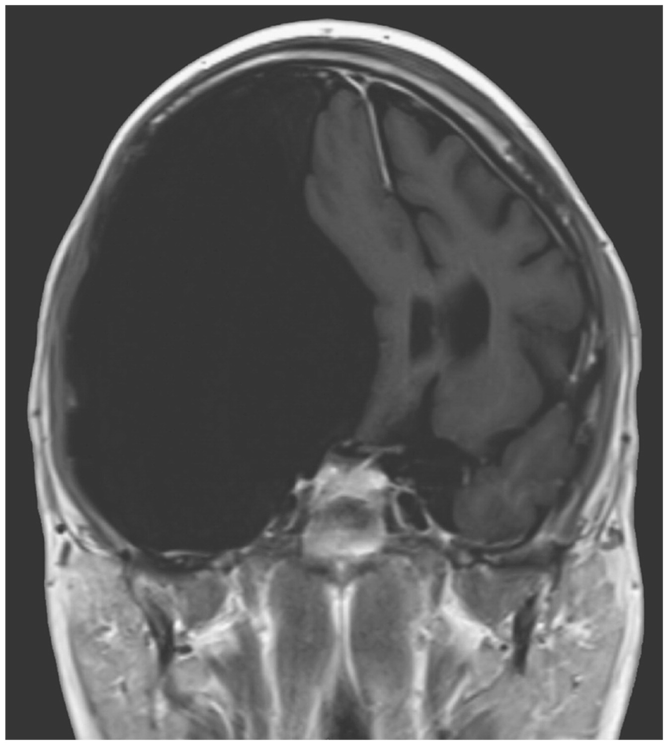 Look At This Incredible Brain Cyst