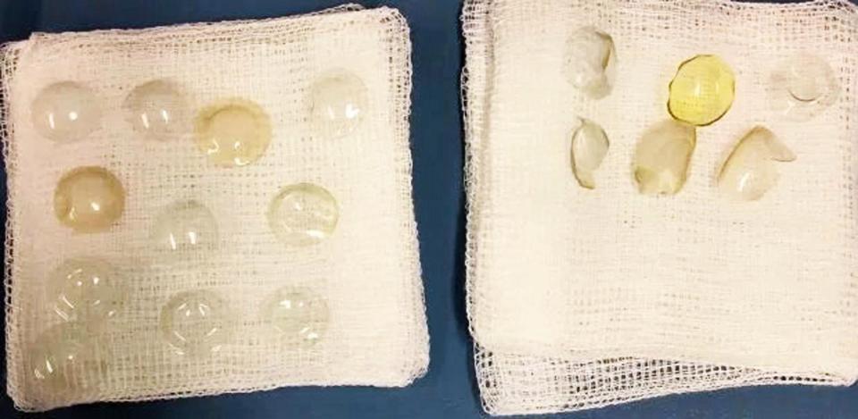 Horrified Surgeons Discover 27 Contact Lenses In Woman’s Eye