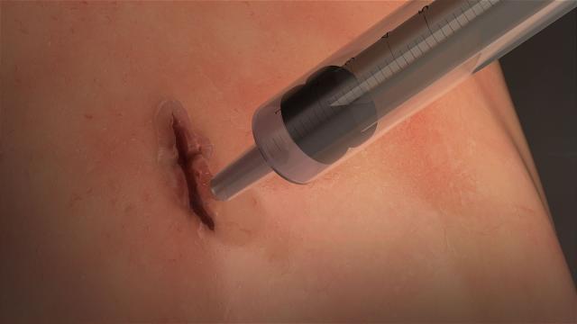 Injectable ‘Elastic Glue’ Seals Wounds In Just 60 Seconds