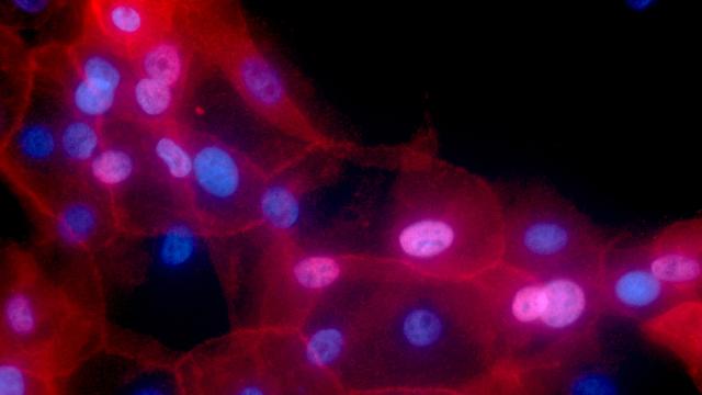 What Genetics Could Tell Us About How Cancer Develops