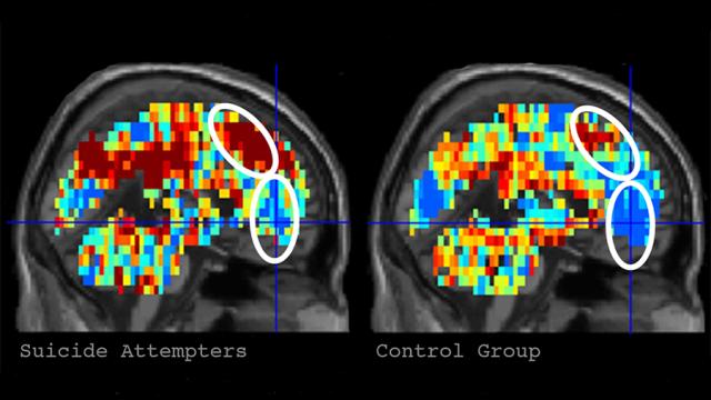 Artificial Intelligence Detects Suicidal Tendencies In People Using Brain Scans