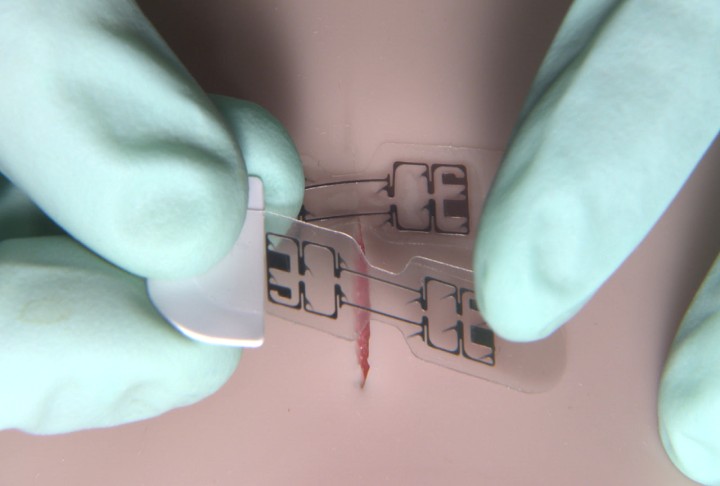 Bandage-Like Gadget Could Make Stitches And Staples A Thing Of The Past