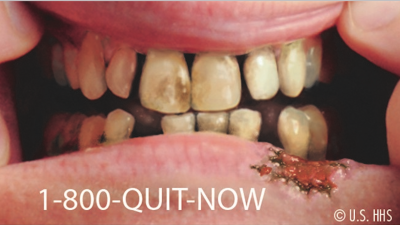 This Revolting Poster Could Increase Teen Smoking Risk, If Teens Are To Be Believed