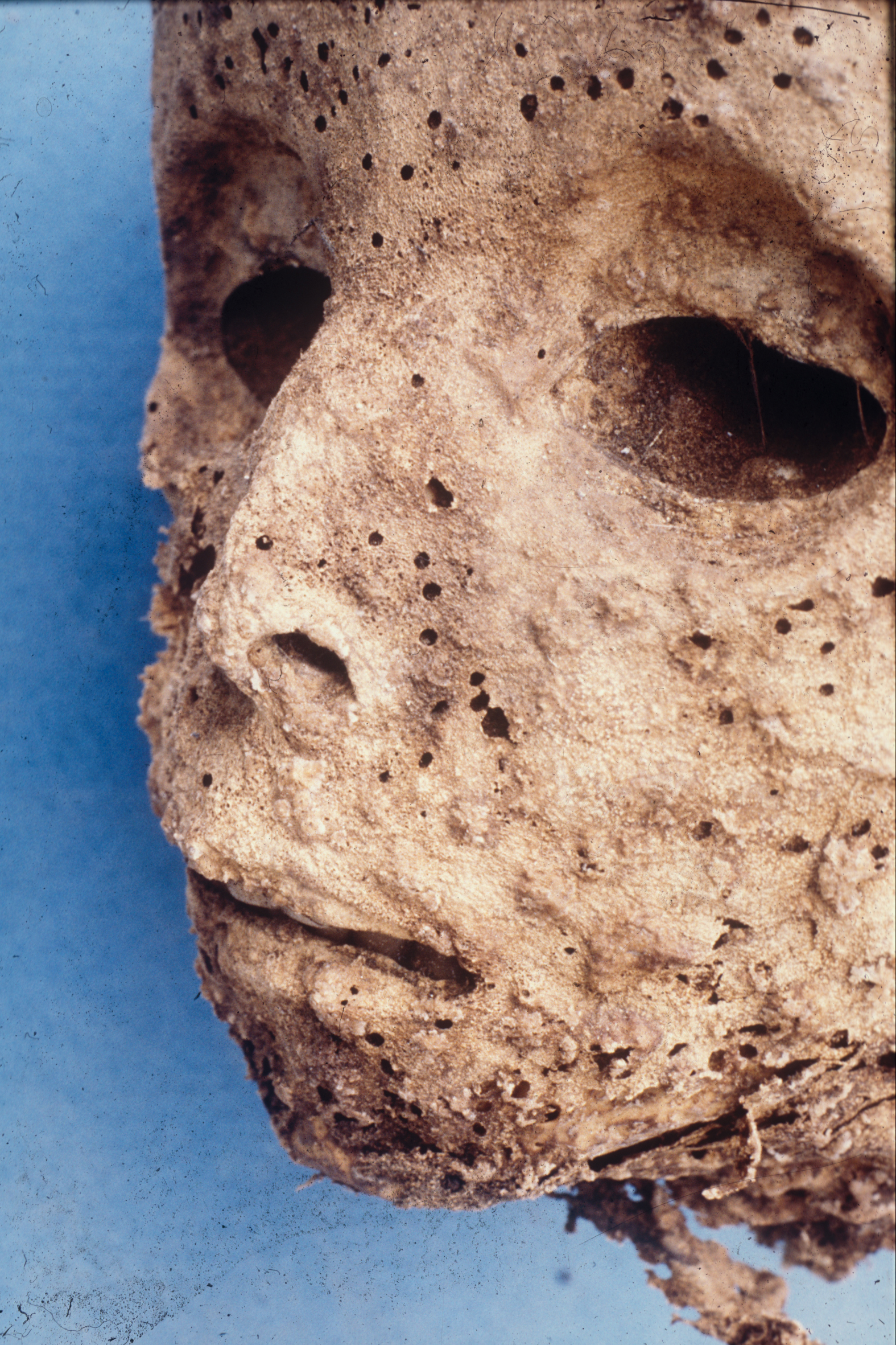 Scientists Discover 16th Century Child Mummy Actually Had Hepatitis B, Not Smallpox 