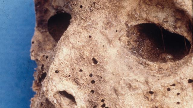 Scientists Discover 16th Century Child Mummy Actually Had Hepatitis B, Not Smallpox 